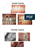 Proses Caries