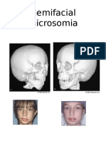 Hemifacial Microsomia