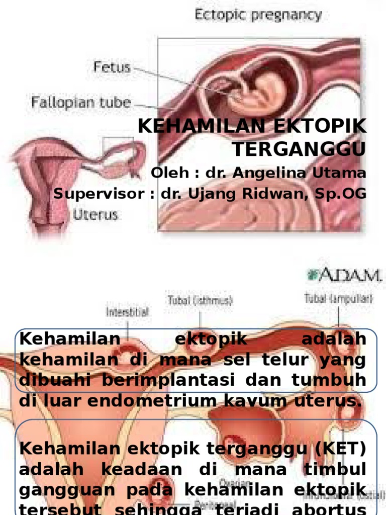 Kehamilan Ektopik Terganggu PDF