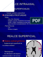 Realce Intraaxial