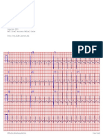 I aVR V1 V4: Case #60