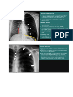 gambar pneumothoraks