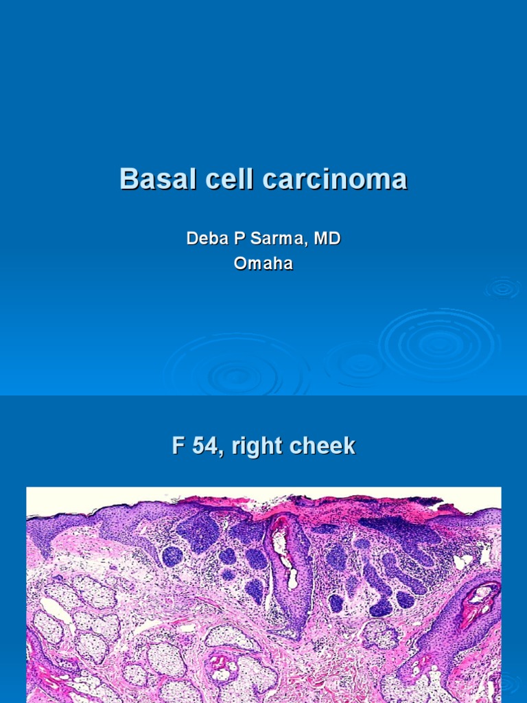 Basal Cell Carcinoma . | PDF