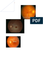 Oclusión arterial retiniana