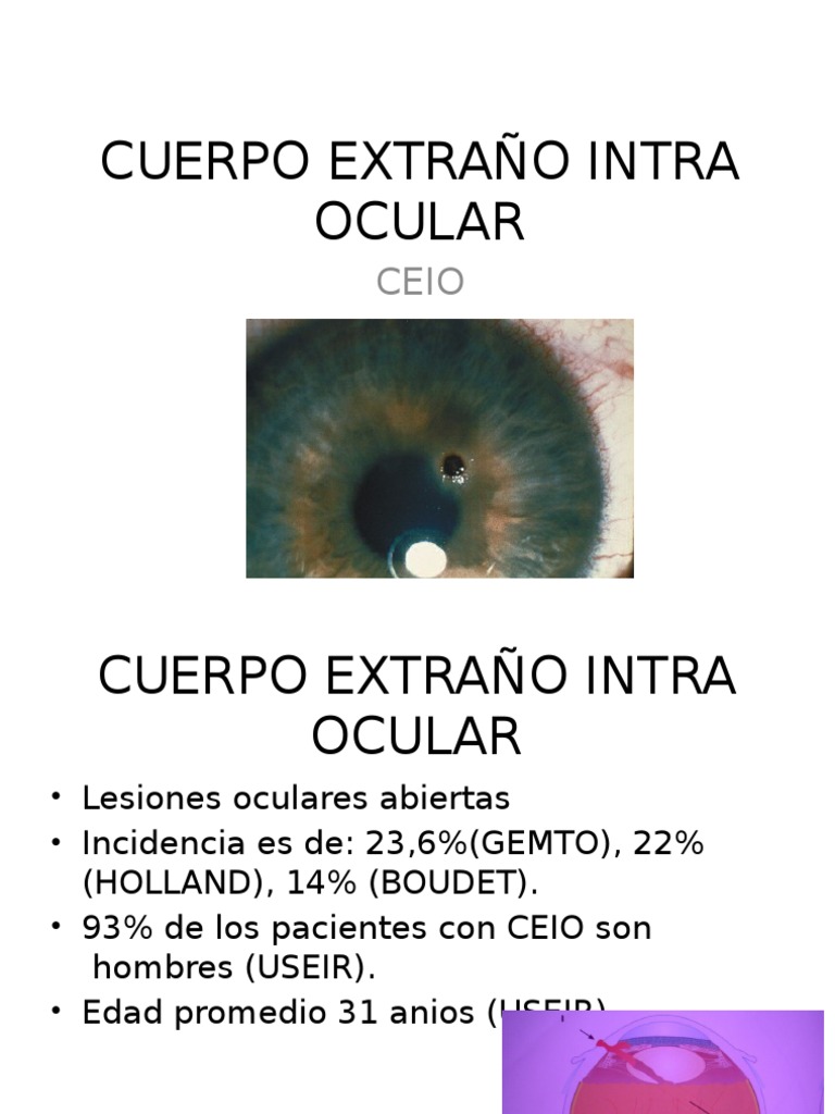Cuerpo Extraño Intra Ocular Expo Ojo humano Catarata