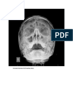 Increased Haziness of Left Maxillary Sinus