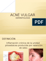 Acne Vulgaris