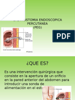 Gastrostomia Endoscopica