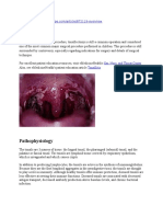 Overview of Tonsillectomy