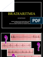Idar Mappangara-Bradiaritmia