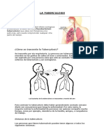 Tuberculosis: causas, síntomas y tratamiento