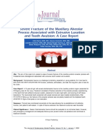 Severe Fracture of The Maxillary Alveolar Process Associated With Extrusive Luxation and Tooth Avulsion A Case Report