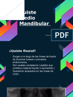 Quiste Mandibular Medio