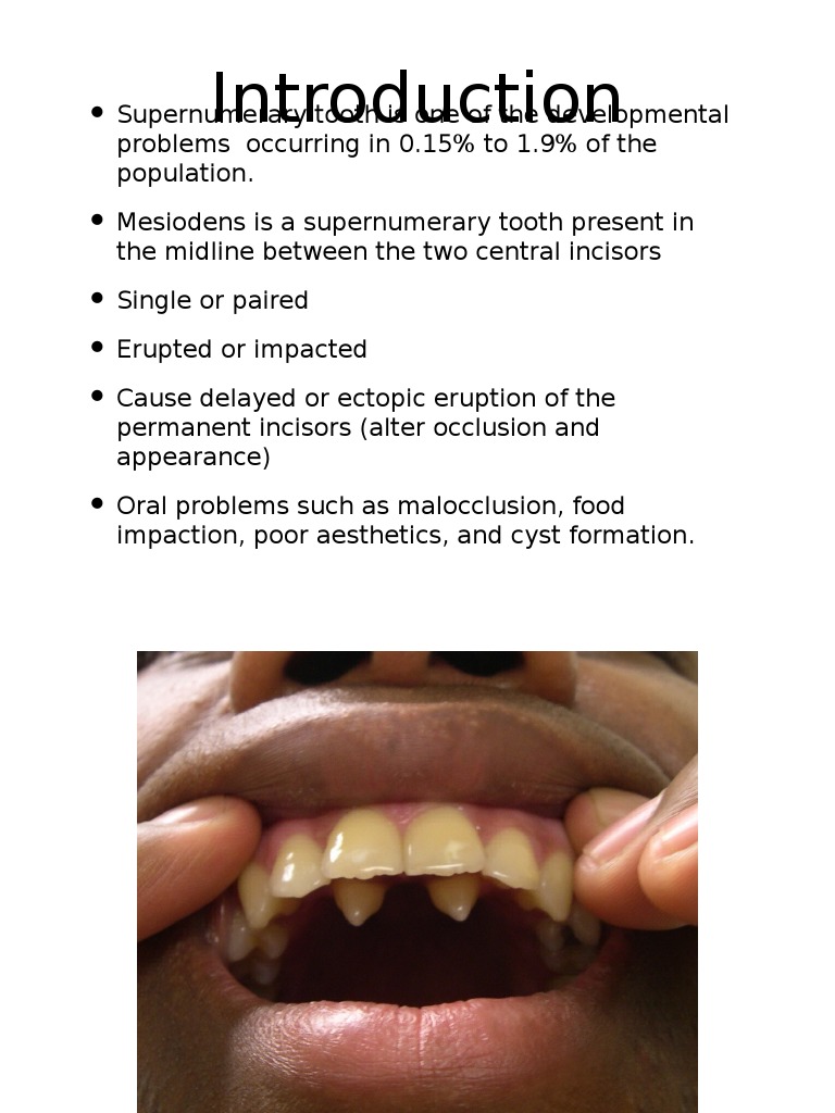 Supernumerary Tooth Mouth Health Sciences