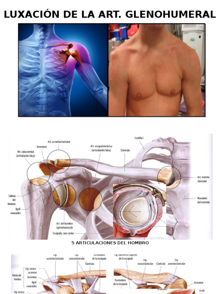 Luxacion Del Hombro PDF Hombro Sistema