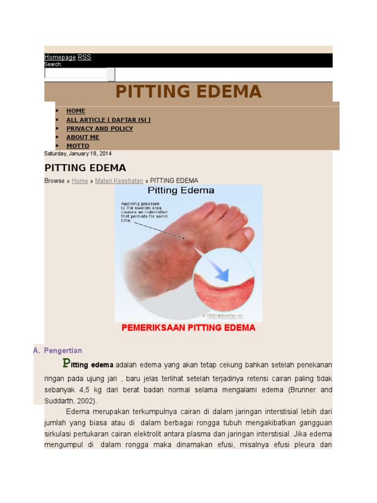 Edema Pitting Pemeriksaan