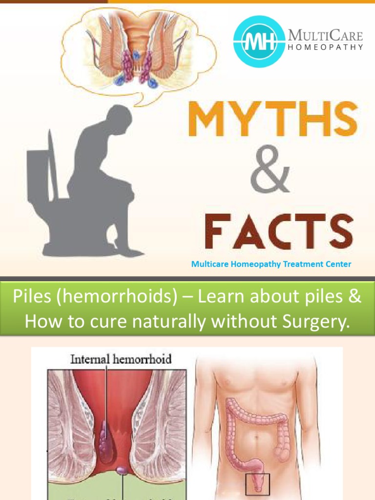 how to cure hemorrhoids naturally for free