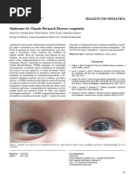 Síndrome de Claude Bernard-Horner