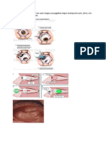 Eye Surgery