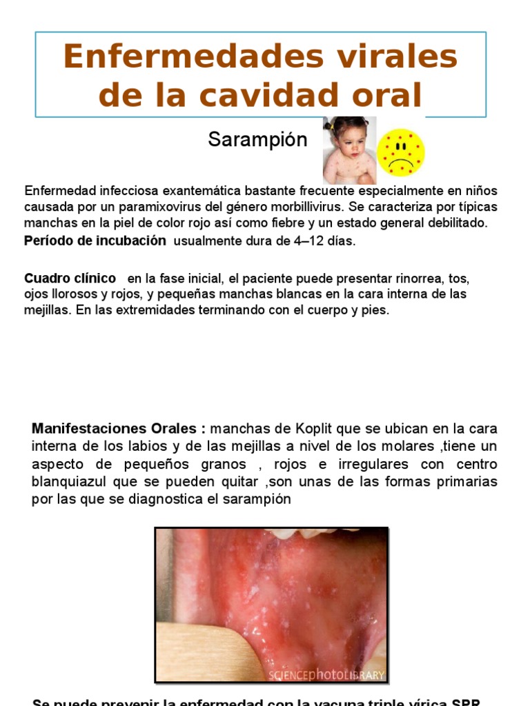 Enfermedades Virales de La Cavidad Oral Sarampión Virus