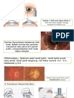 Pem. Glaukoma