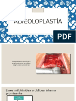 Alveoloplastía