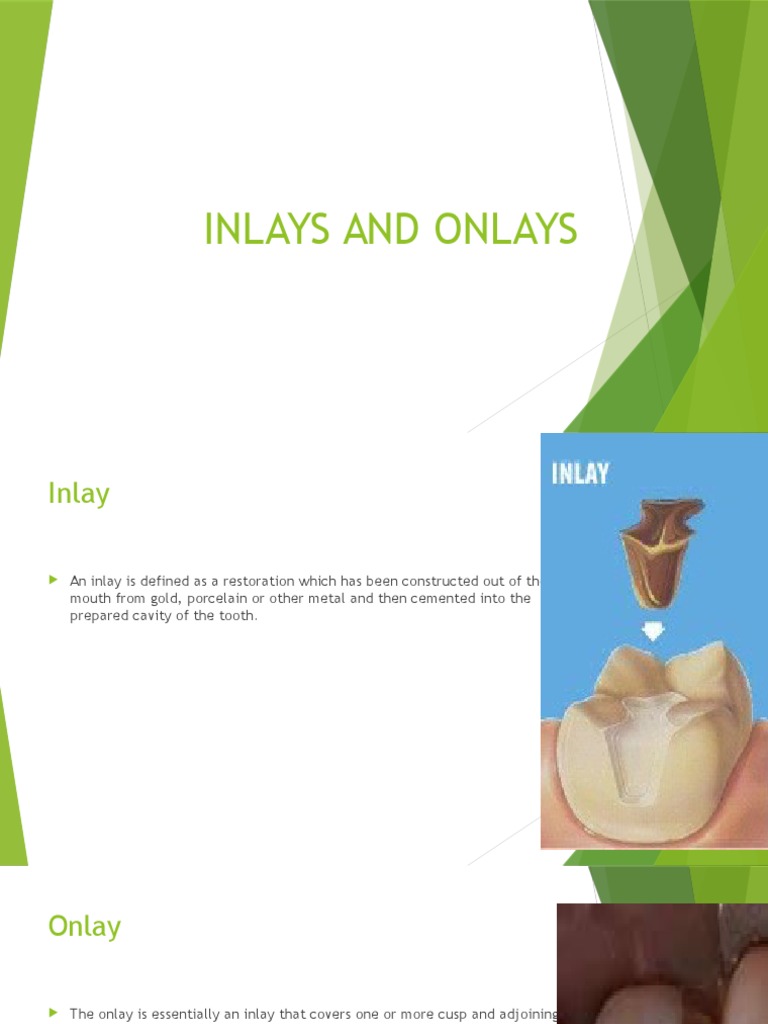 Inlays and Onlays in Dentistry | PDF | Mouth | Dentistry