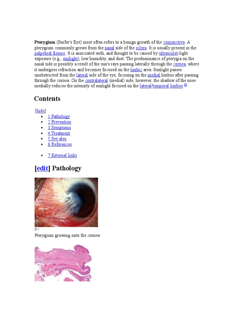 Understanding Pterygium Pathology | PDF