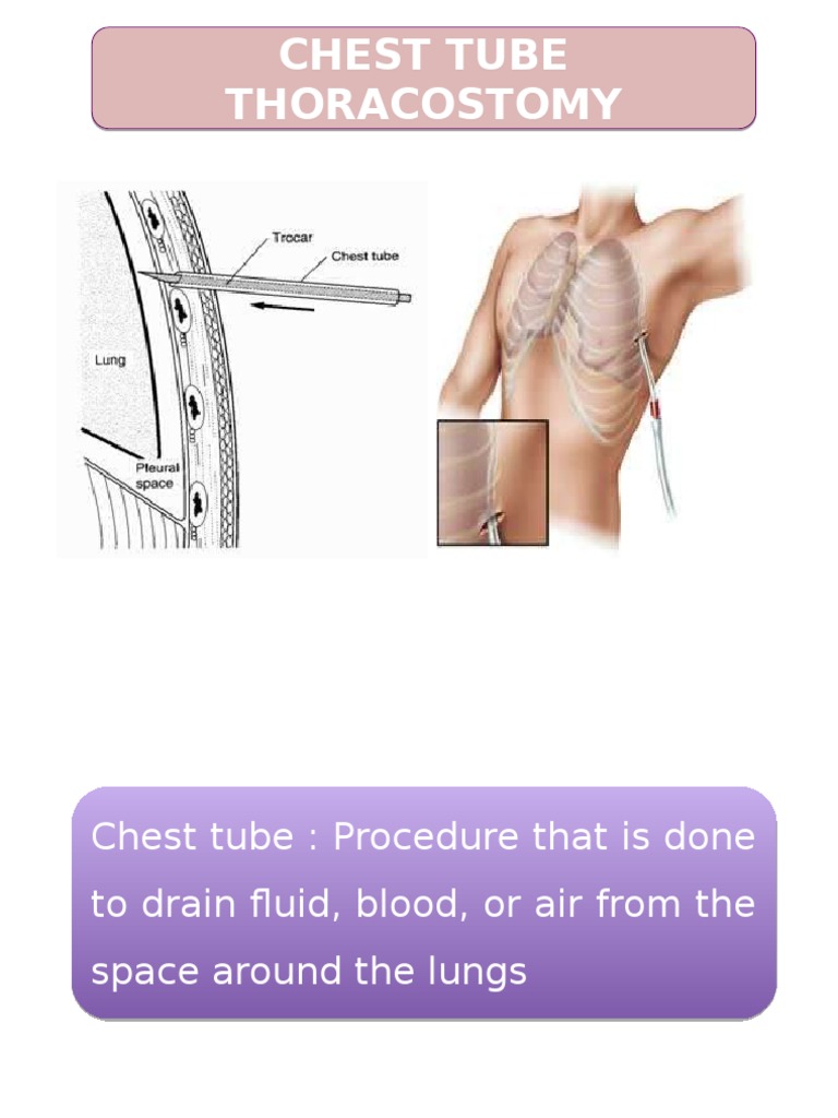 Pemasangan dan Pengelolaan Chest Tube | PDF