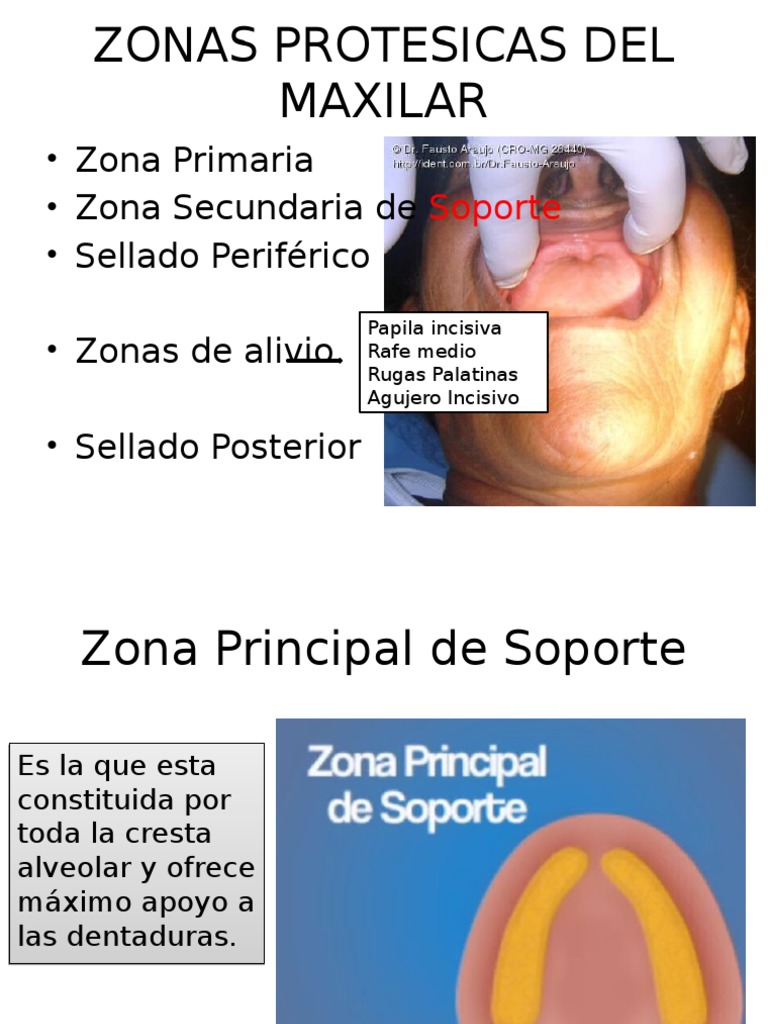 Zonas Protesicas Del Maxilar | PDF