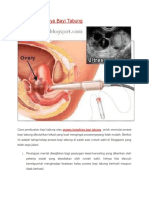 Proses Terjadinya Bayi Tabung.