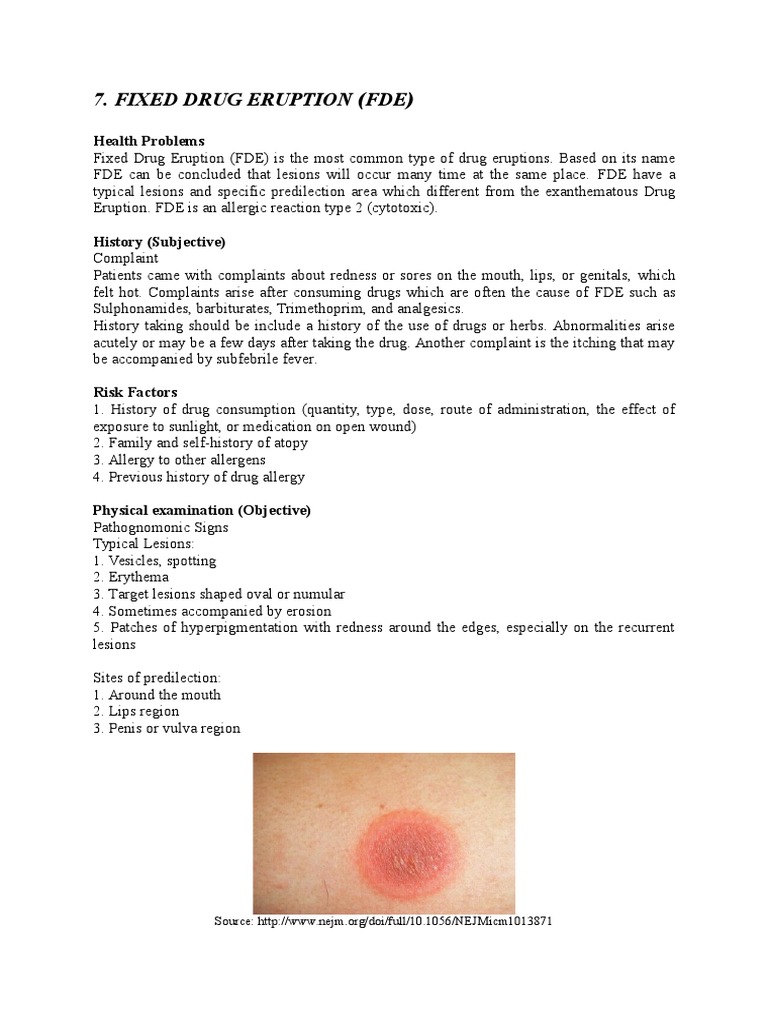 Fixed Drug Eruption PDF Allergy Medical Diagnosis