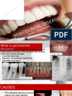 Causes and Symptoms of Periodontal Disease