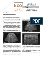 Plastron Apendicular Retrocecal