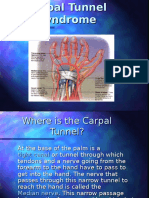 Carpal Tunnel Syndrome