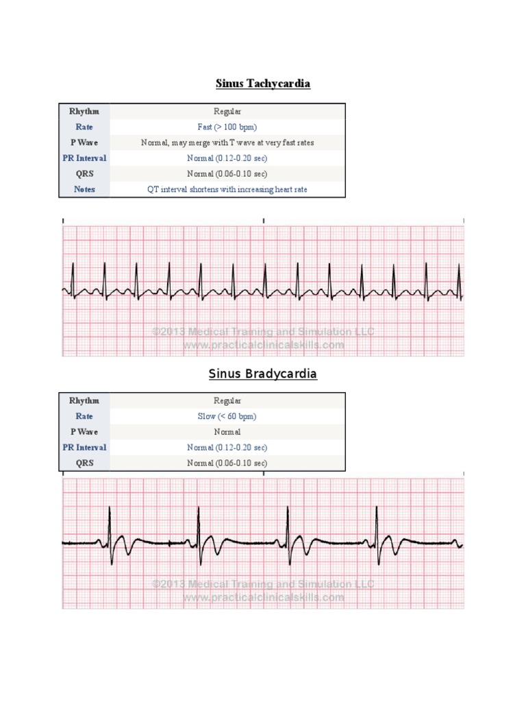 Ekg Strip Notes Cardiac Arrhythmia Cardiovascular Physiology