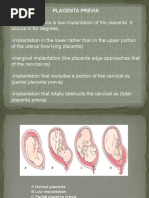 Placenta Previa