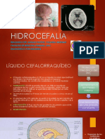 Hidrocefalia 