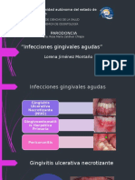 Infeccion Gingival Aguda