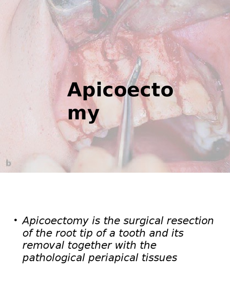 Apicoectomy.pptx Dental Anatomy Surgery