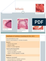 Oral Candidiasis