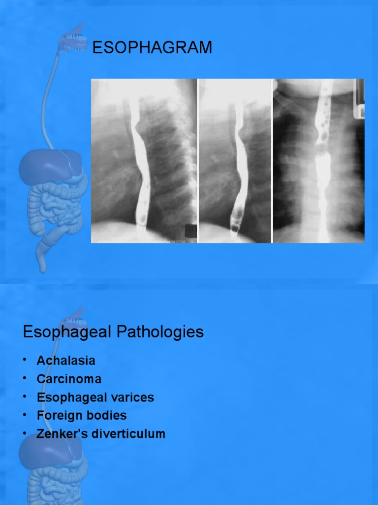Esophagram: Barium Swallow Insights | PDF | Esophagus ...