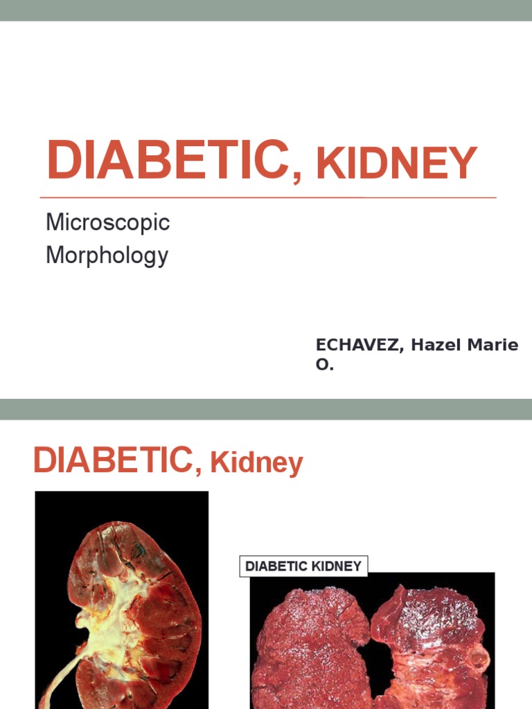 Histological Changes in Diabetic Kidneys: A Comparison of Normal and ...