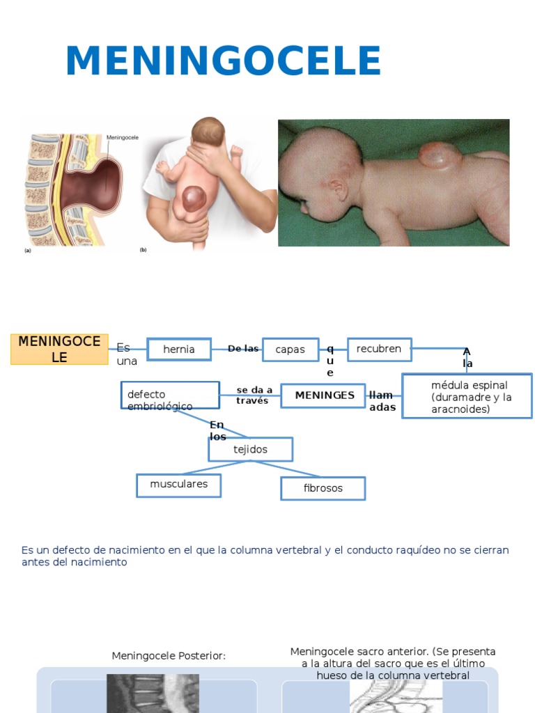 Meningocele y Mielomeningocele Hidrocefalio Meningitis | PDF ...