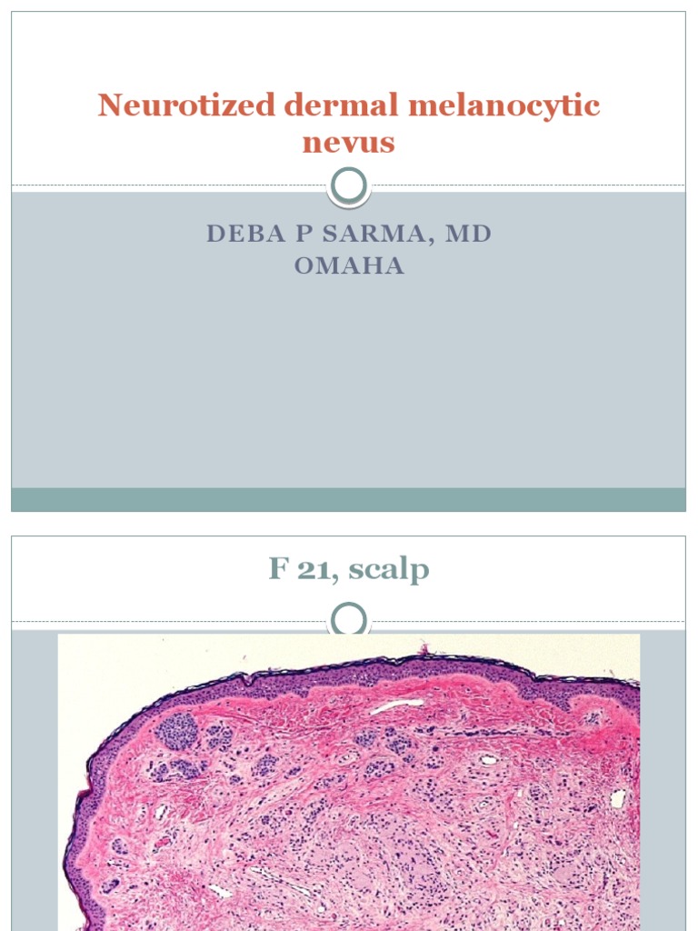 Neurotized Dermal Melanocytic Nevus. F 21, Scalp. | PDF