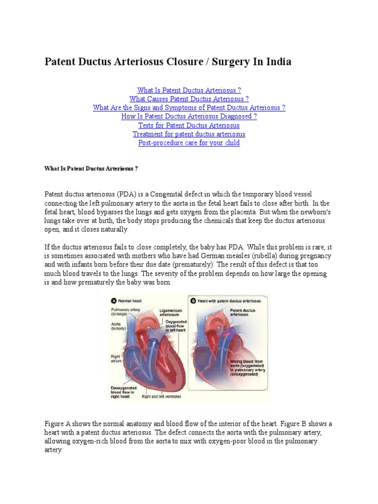 Patent Ductus Arteriosus Closure | PDF | Congenital Heart Defect | Heart