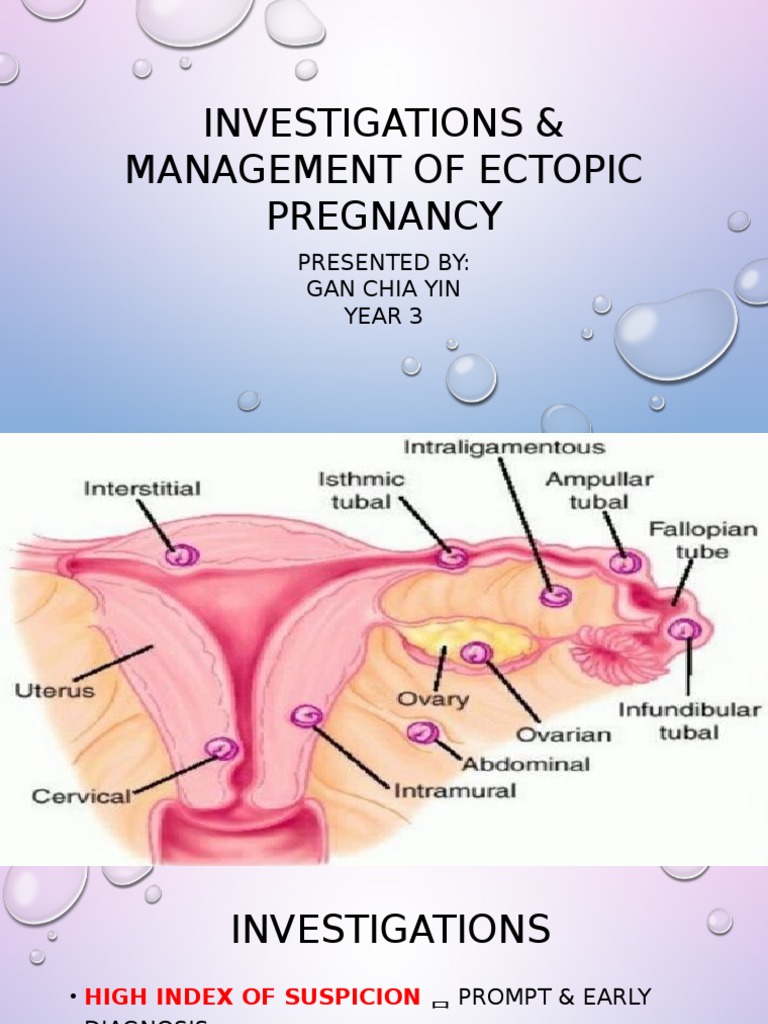 3 Investigation & Management of Ectopic Pregnancy PDF