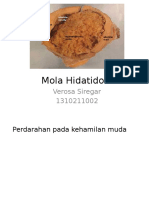 Mola Hidatidosa