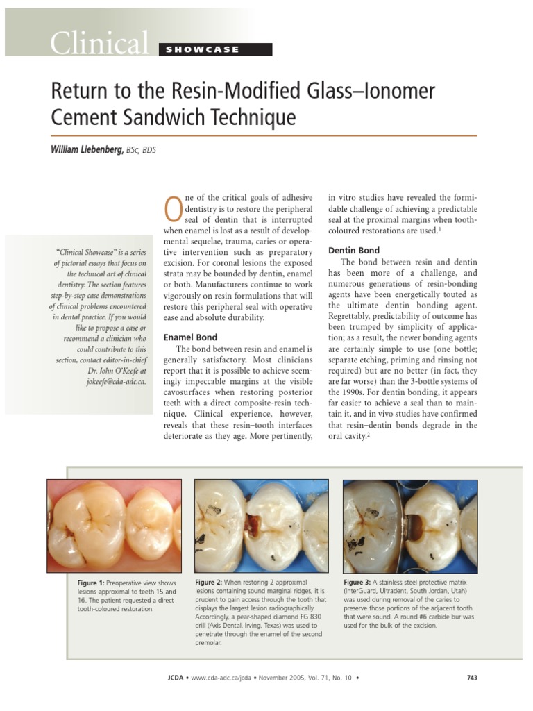 Clinical Return To The ResinModified GlassIonomer Cement Sandwich Technique PDF