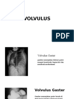 Volvulus